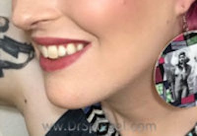 Mandible Contouring Before & After Gallery - Patient 157139961 - Image 4