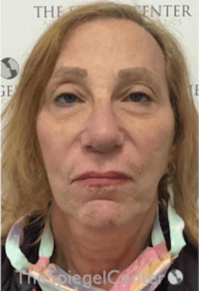 Facelift Before & After Gallery - Patient 157139969 - Image 1