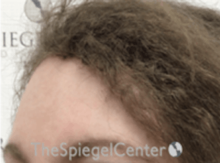 Forehead Contouring Before & After Gallery - Patient 157139962 - Image 4