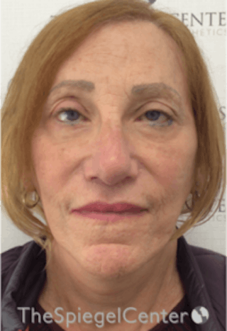 Facelift Before & After Gallery - Patient 157139969 - Image 2