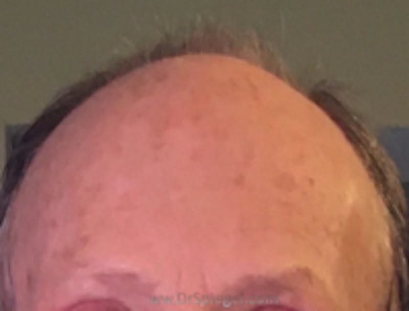 Browlift / Fox Eye Lift Before & After Gallery - Patient 157139964 - Image 2