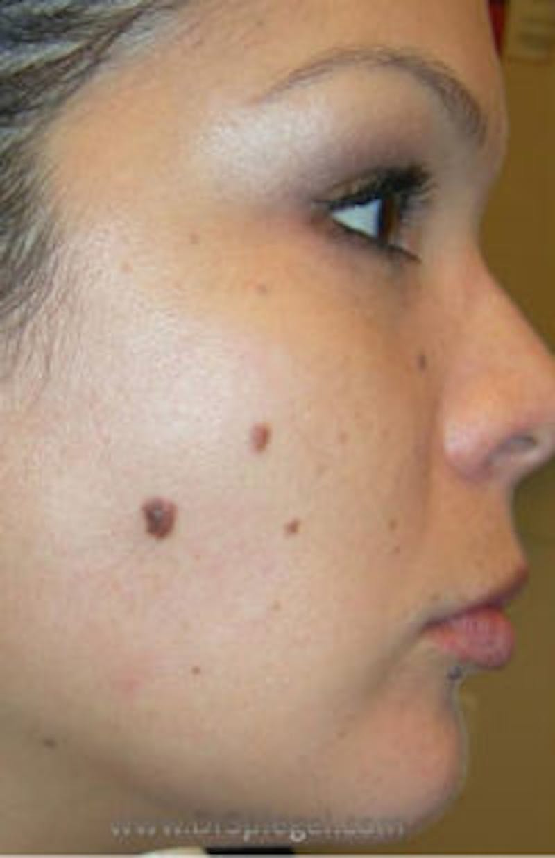 Mole Removal Before & After Gallery - Patient 157139966 - Image 1