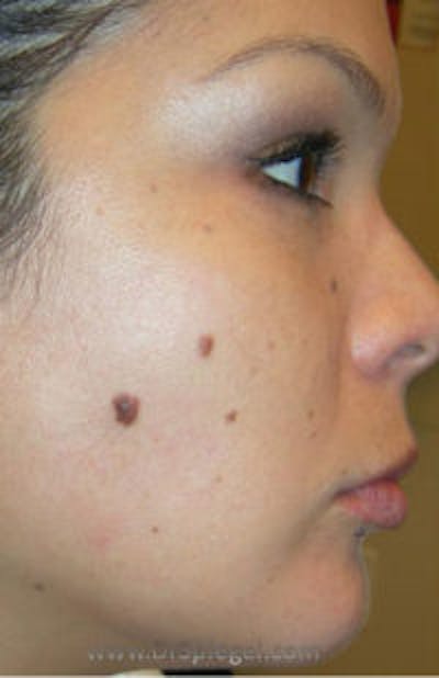 Mole Removal Before & After Gallery - Patient 157139966 - Image 1