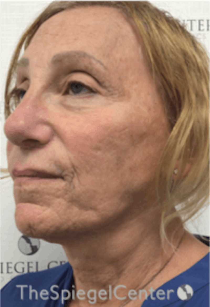 Facelift Before & After Gallery - Patient 157139969 - Image 3