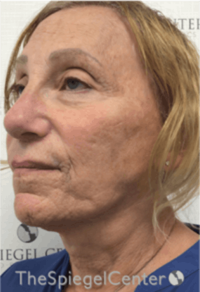 Facelift Before & After Gallery - Patient 157139969 - Image 3