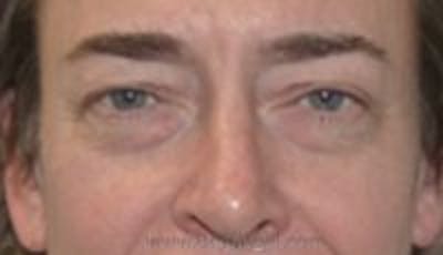 Blepharoplasty Before & After Gallery - Patient 157139970 - Image 1