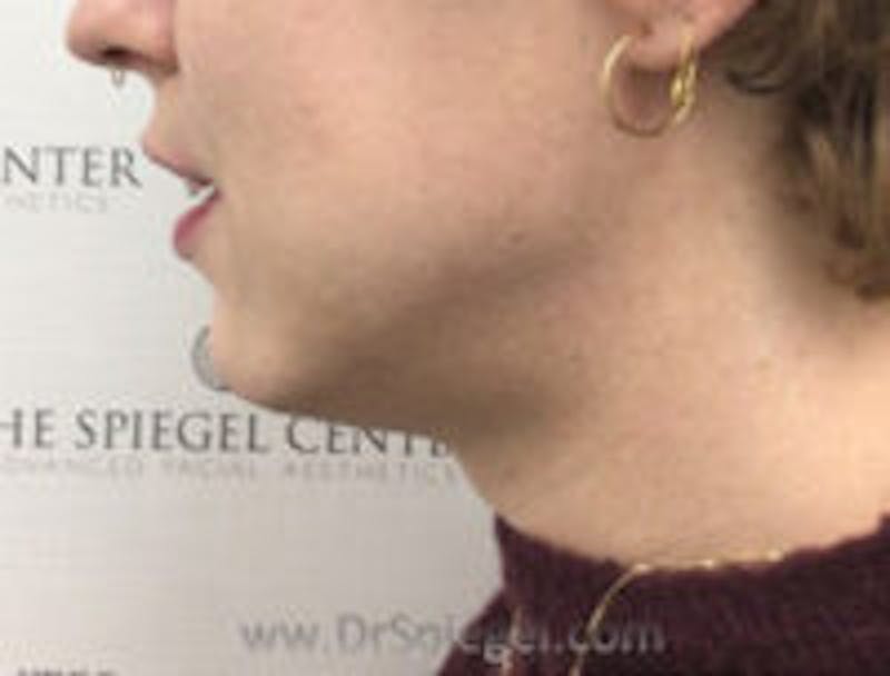 Mandible Contouring Before & After Gallery - Patient 157139971 - Image 3