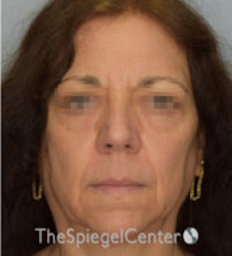 Facelift Before & After Gallery - Patient 157139980 - Image 1