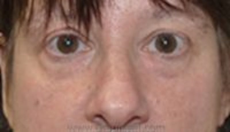 Blepharoplasty Before & After Gallery - Patient 157139974 - Image 1