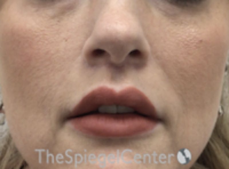 Lip Augmentation / Lip Implant / Lip Lift Before & After Gallery - Patient 157139979 - Image 2