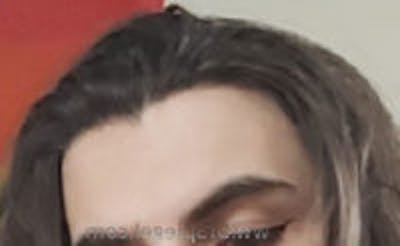 Browlift / Fox Eye Lift Before & After Gallery - Patient 157139978 - Image 1