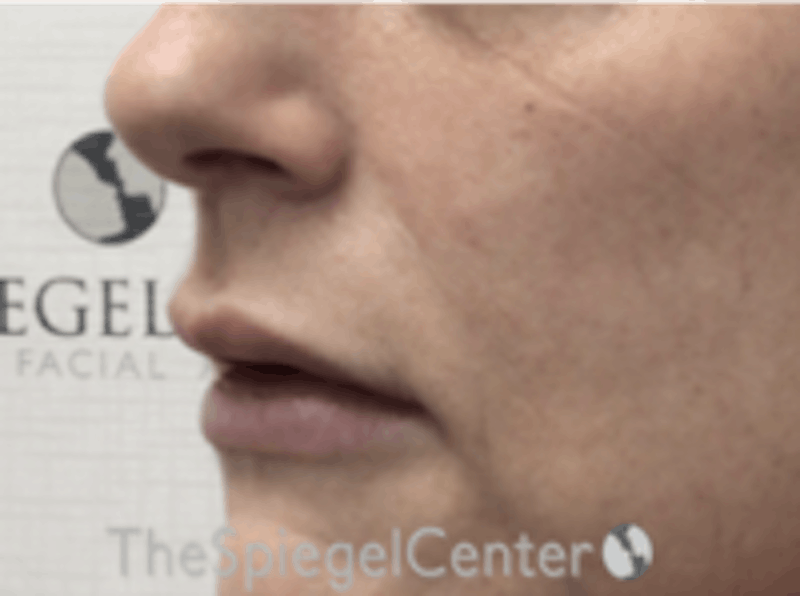 Lip Lift Before & After Gallery - Patient 157139979 - Image 3