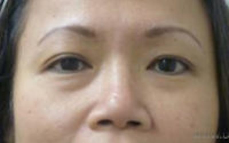 Monolid / Double Eyelid Surgery Before & After Gallery - Patient 157139981 - Image 1