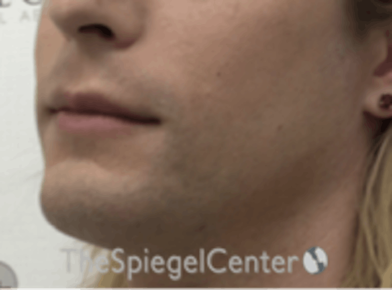 Mandible Contouring Before & After Gallery - Patient 157139982 - Image 3