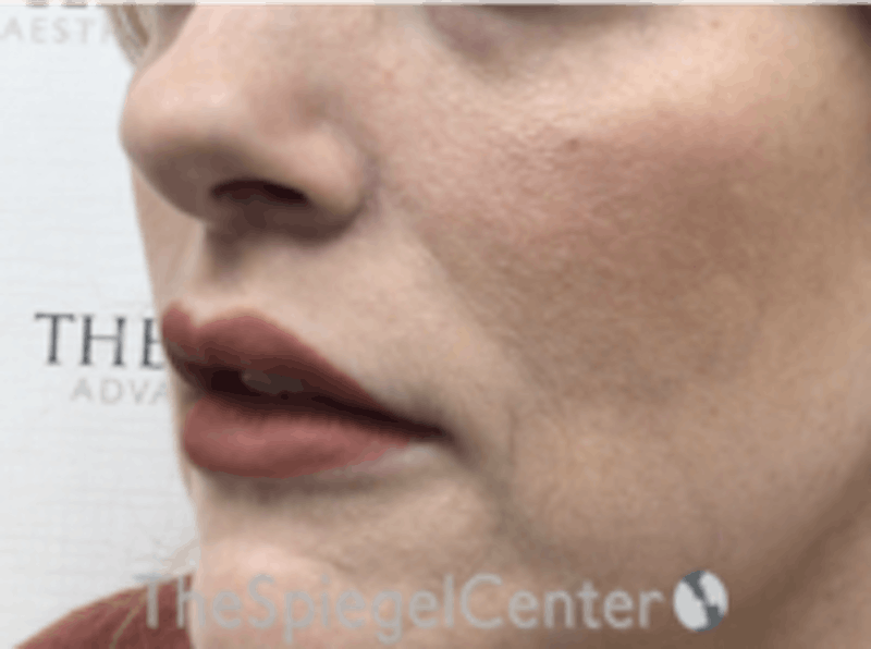 Lip Augmentation / Lip Implant / Lip Lift Before & After Gallery - Patient 157139979 - Image 4