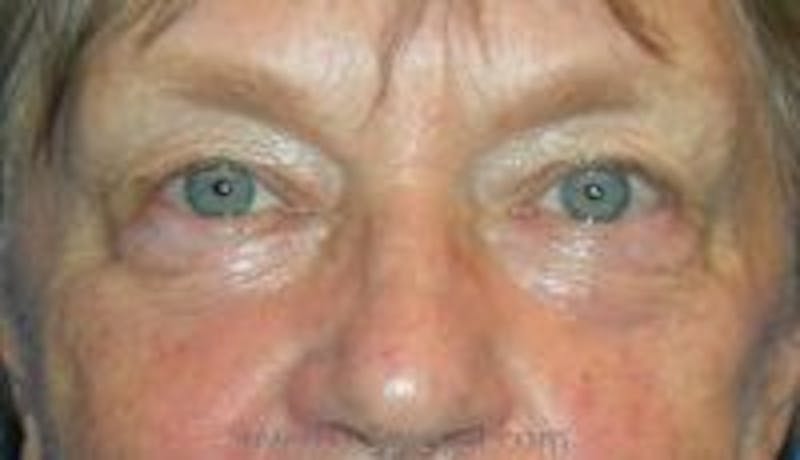 Blepharoplasty Before & After Gallery - Patient 157139983 - Image 1