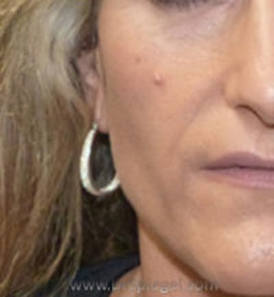 Mole Removal Before & After Gallery - Patient 157139986 - Image 1