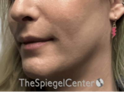 Mandible Contouring Before & After Gallery - Patient 157139982 - Image 4