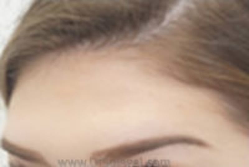 Browlift / Fox Eye Lift Before & After Gallery - Patient 157139987 - Image 1
