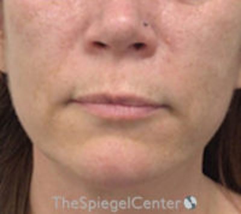 Lip Lift Before & After Gallery - Patient 157139990 - Image 1