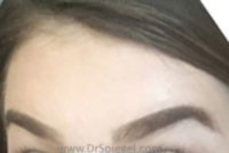 Browlift / Fox Eye Lift Before & After Gallery - Patient 157139987 - Image 2
