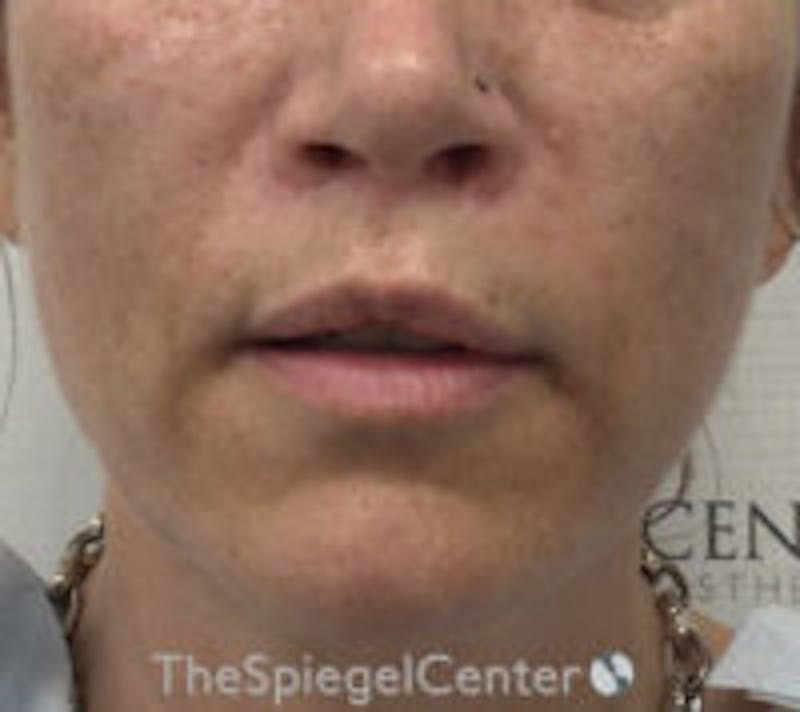 Lip Augmentation / Lip Implant / Lip Lift Before & After Gallery - Patient 157139990 - Image 2