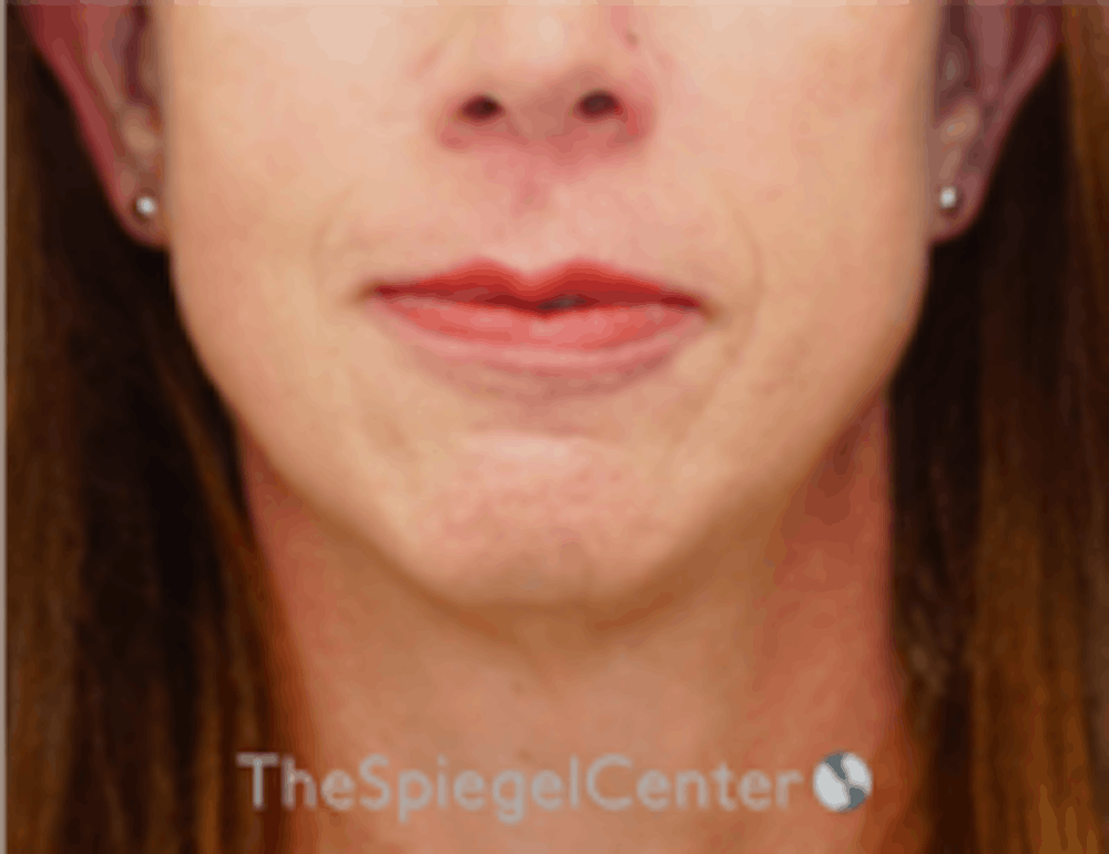 Mandible Contouring