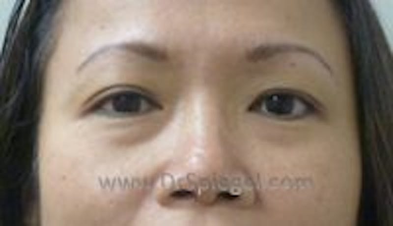 Blepharoplasty Before & After Gallery - Patient 157139988 - Image 1