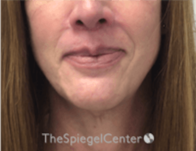 Mandible Contouring Before & After Gallery - Patient 157139994 - Image 2