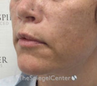 Lip Lift Before & After Gallery - Patient 157139990 - Image 4