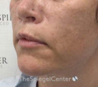 Lip Lift Before & After Gallery - Patient 157139990 - Image 4