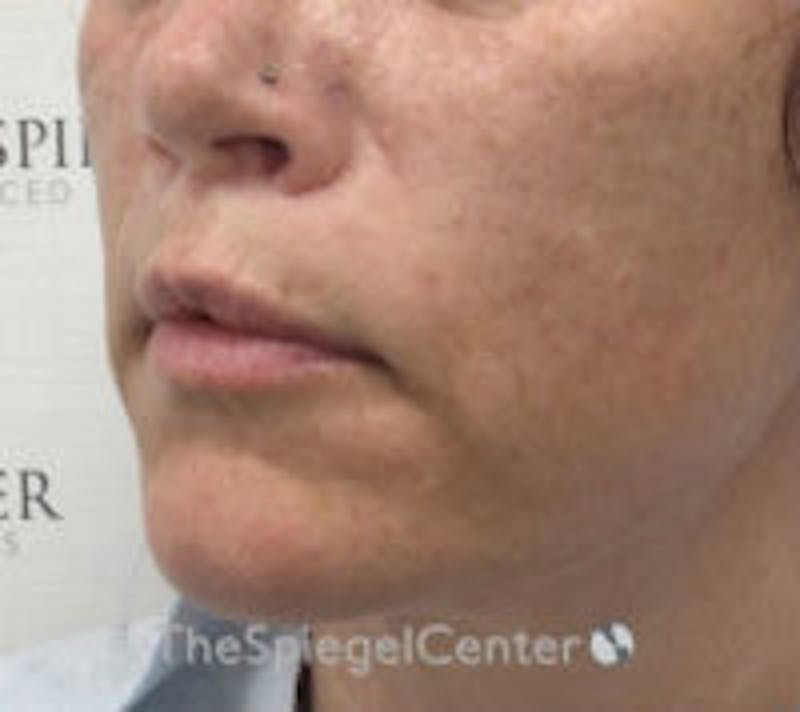 Lip Augmentation / Lip Implant / Lip Lift Before & After Gallery - Patient 157139990 - Image 4