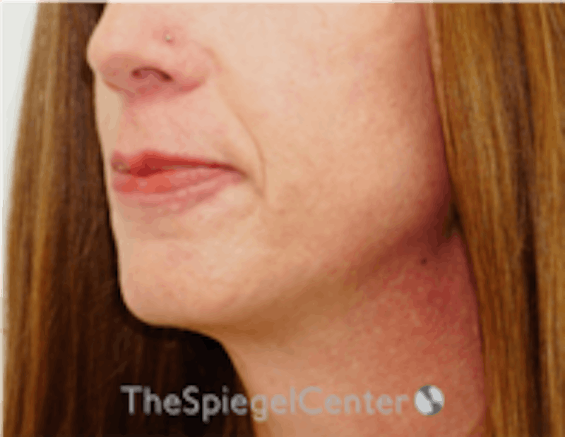 Mandible Contouring Before & After Gallery - Patient 157139994 - Image 3