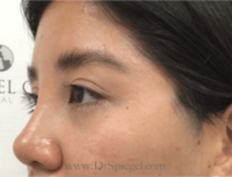 Monolid / Double Eyelid Surgery Before & After Gallery - Patient 157139993 - Image 4