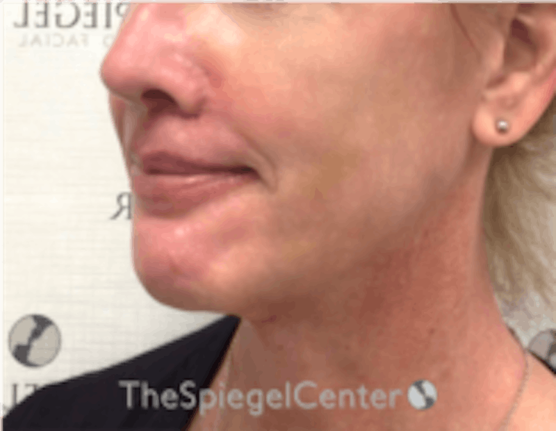 Mandible Contouring Before & After Gallery - Patient 157139994 - Image 4
