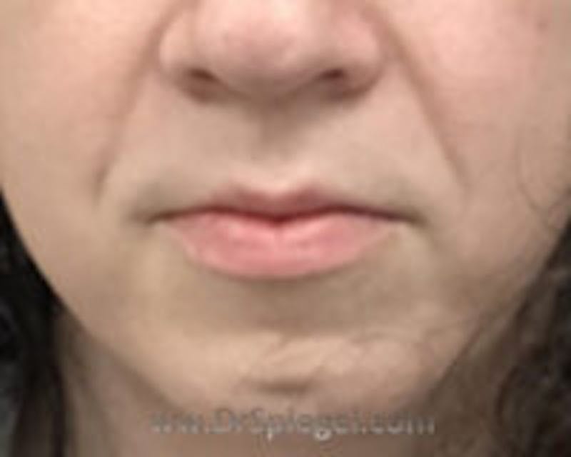 Lip Lift Before & After Gallery - Patient 157140001 - Image 1