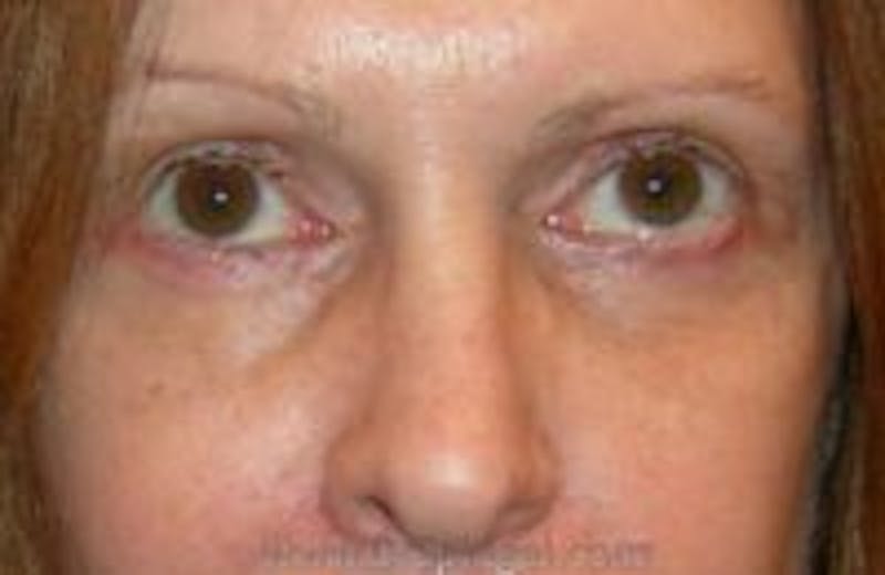 Blepharoplasty Before & After Gallery - Patient 157139996 - Image 2