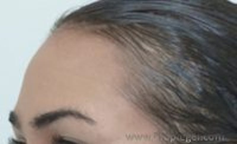 Browlift / Fox Eye Lift Before & After Gallery - Patient 157139999 - Image 2