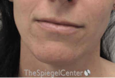 Mandible Contouring Before & After Gallery - Patient 157140008 - Image 1