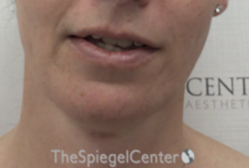 Mandible Contouring Before & After Gallery - Patient 157140008 - Image 2