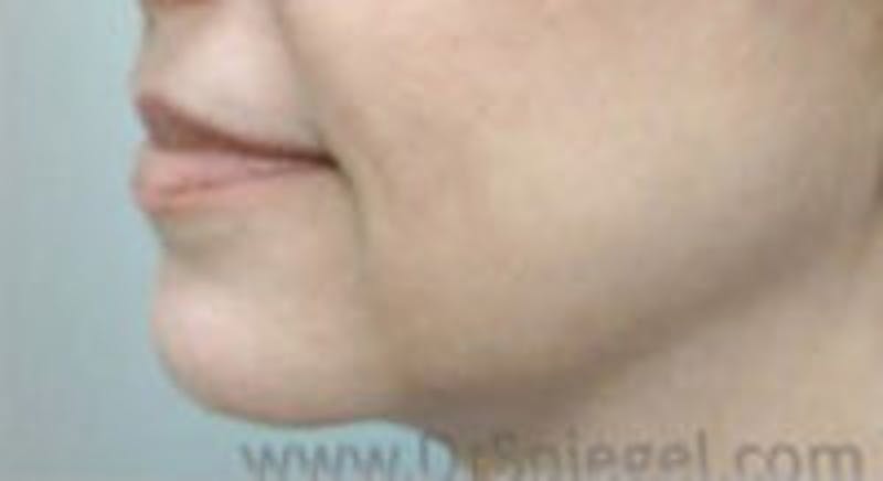 Facelift Before & After Gallery - Patient 157140006 - Image 1
