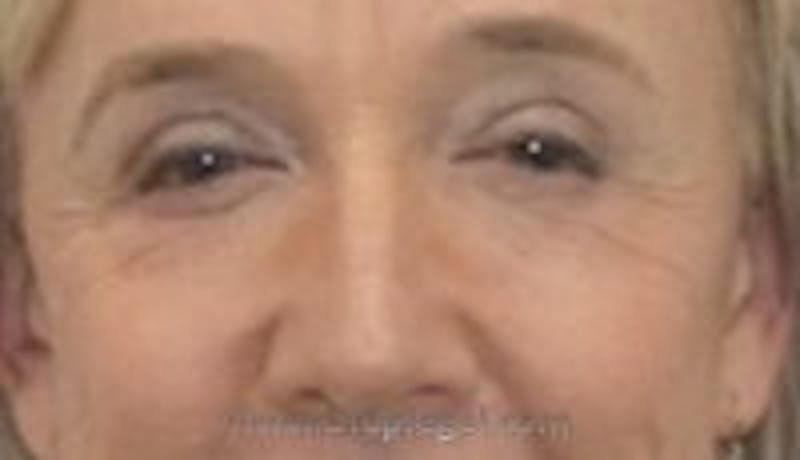 Blepharoplasty Before & After Gallery - Patient 157140004 - Image 2