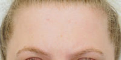 Mole Removal Before & After Gallery - Patient 157140003 - Image 2