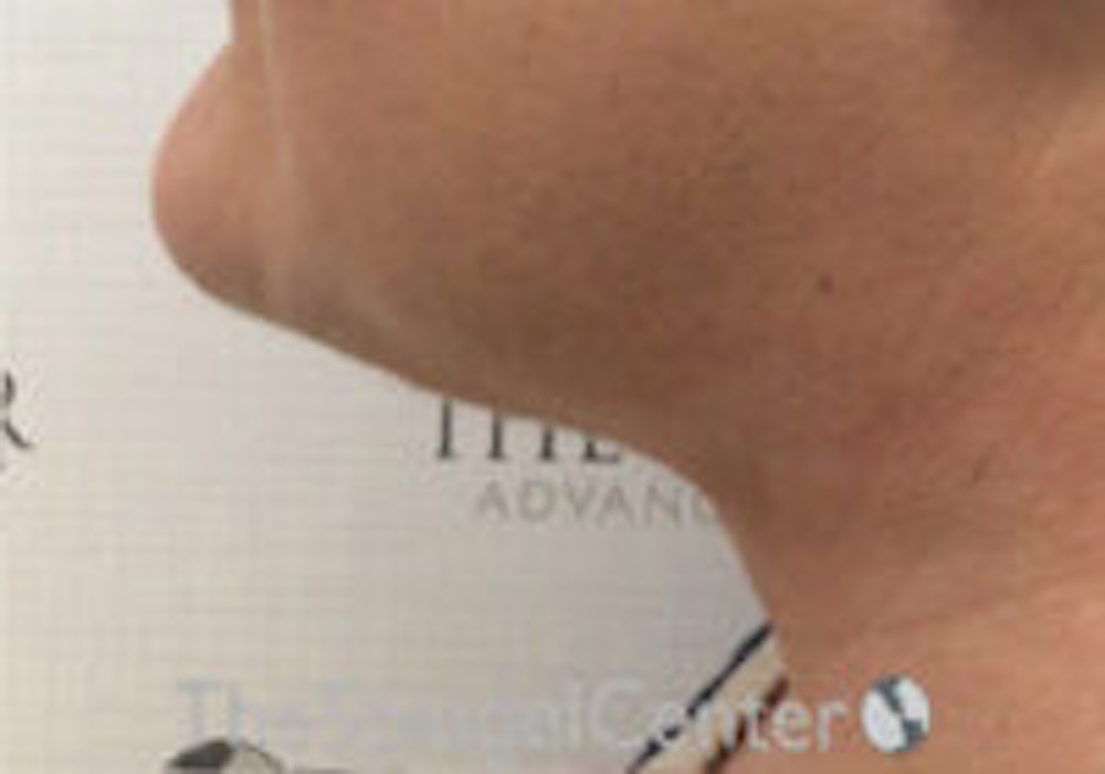 Before and After photos of neck lift in Boston