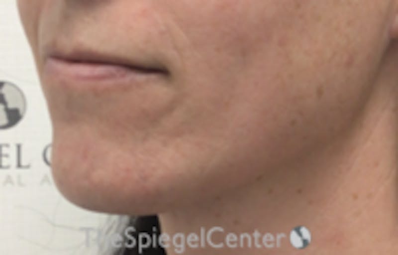 Mandible Contouring Before & After Gallery - Patient 157140008 - Image 3