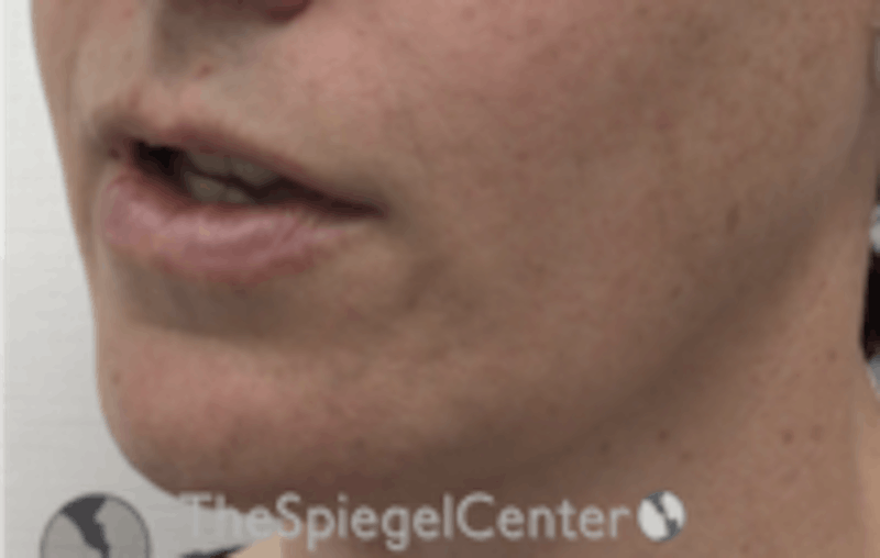 Mandible Contouring Before & After Gallery - Patient 157140008 - Image 4