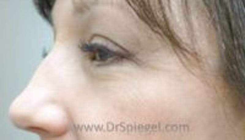 Blepharoplasty Before & After Gallery - Patient 157140010 - Image 1