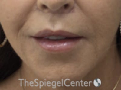 Lip Lift Before & After Gallery - Patient 157140015 - Image 2