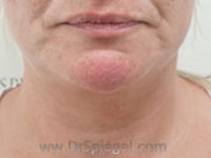 Neck Lift Before & After Gallery - Patient 157140017 - Image 3