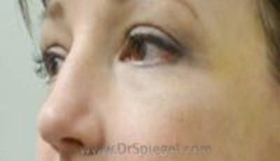 Blepharoplasty Before & After Gallery - Patient 157140010 - Image 2